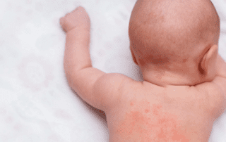 درمان اگزما در کودکان