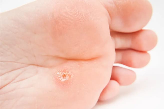 Plantar-warts درمان قطعی میخچه کف پا