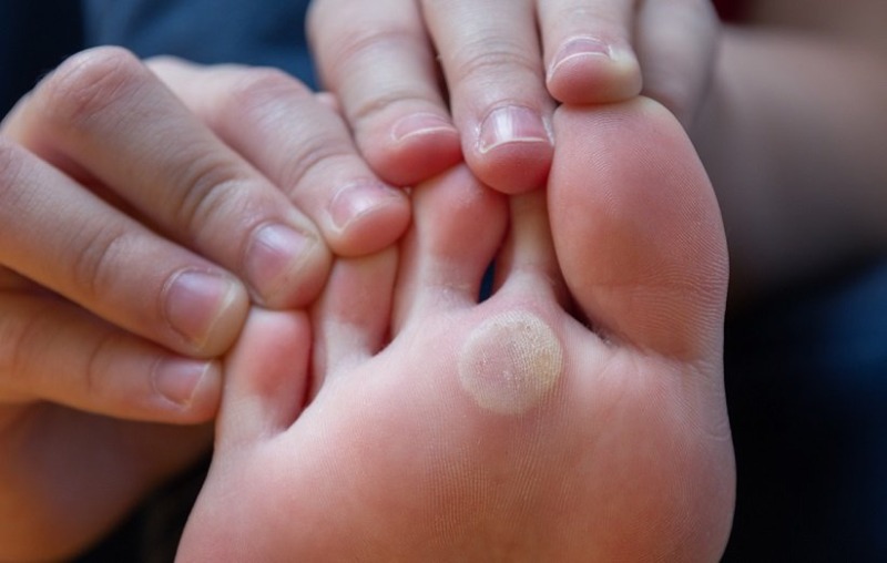 درمان میخچه کف پا با سیر
