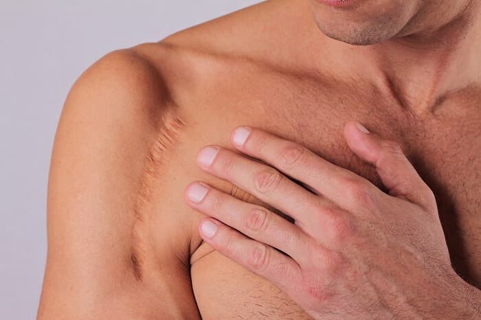 What-is-a-skin-scar-and-ways-to-treat-and-prevent-it اسکار پوست چیست