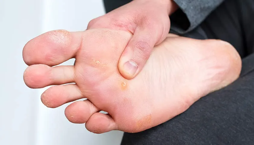 عکس پینه پا