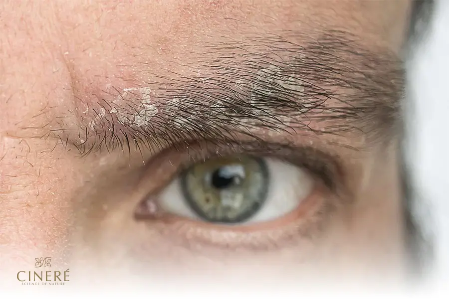 بیماری‌های پوستی مزمن یکی از دلایل ریختن موهای ابرو است.