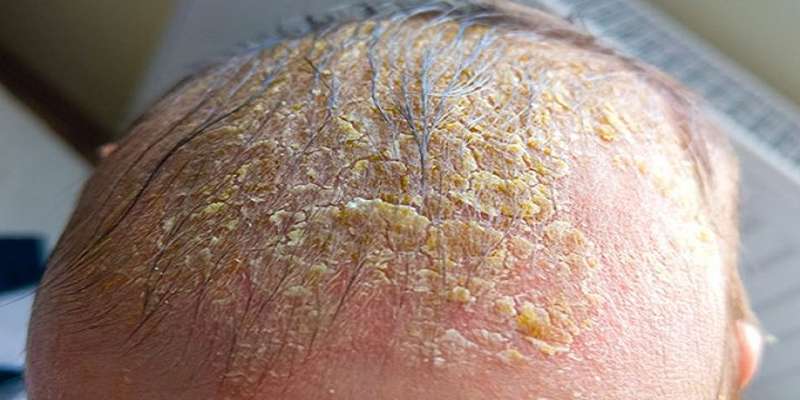 کلاه گهواره (Cradle cap)