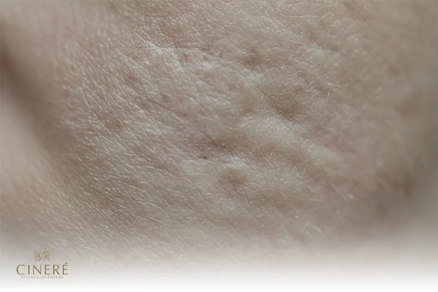 آلودگی هوا باعث کاهش طراوت پوست میشود