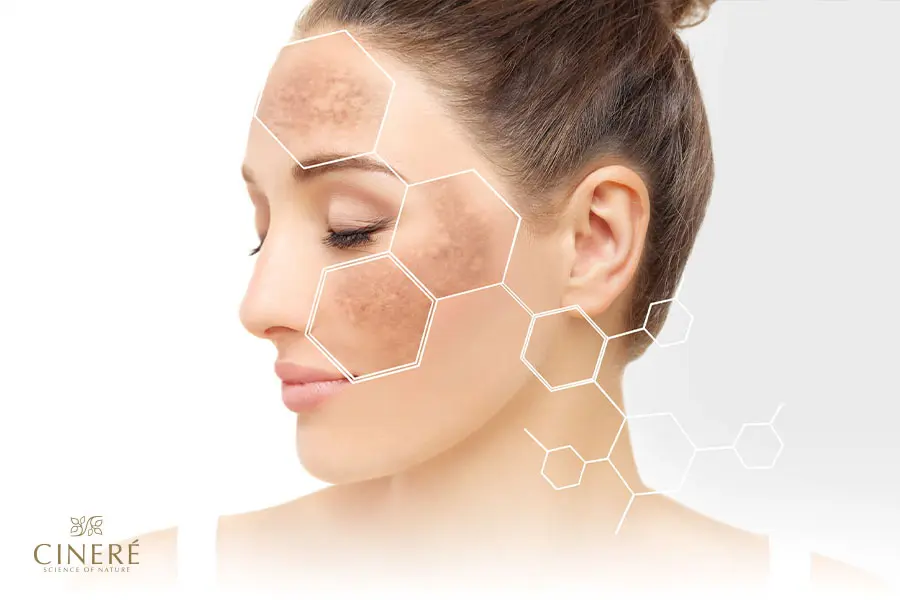 تغییر رنگ و تیرگی پوست بهدلیل آفتاب سوختگی