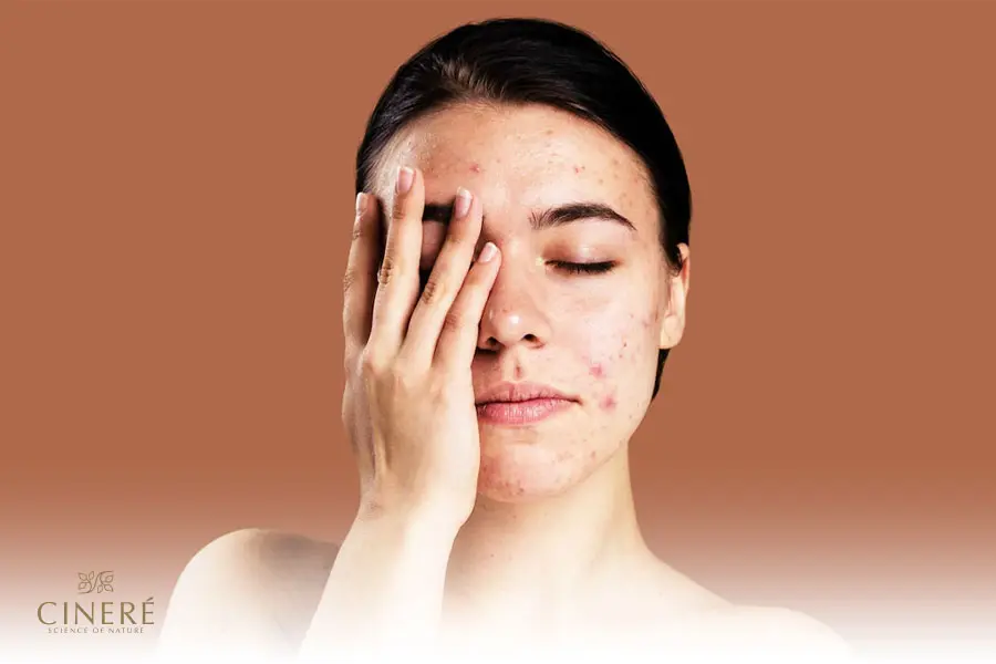 با توجه به ضرر پارابن برای پوست بهتر است از محصولات بدون پارابن استفاده کنید.