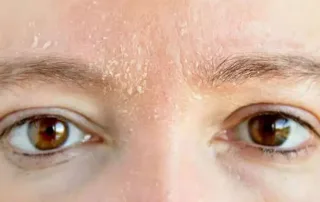 علت و درمان شوره ابرو