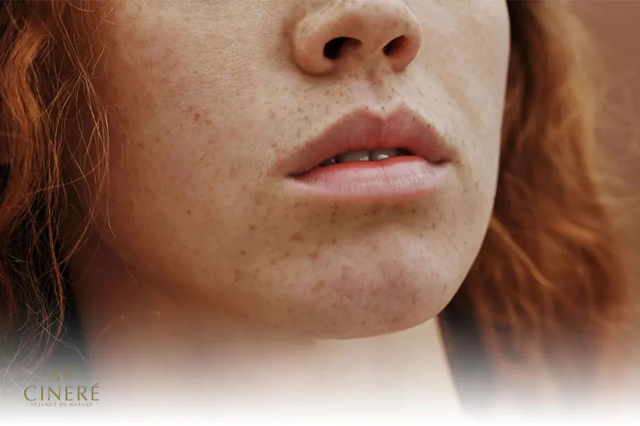 لک قهوه ای صورت دلایل متعددی میتواند داشته باشد.