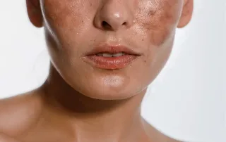 سریع‌ترین راه از بین بردن لک قهوه ‌ای صورت