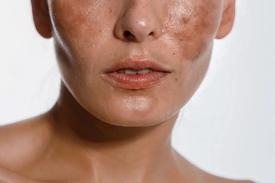 سریع‌ترین راه از بین بردن لک قهوه ‌ای صورت