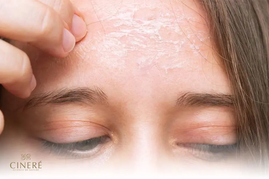 پوسته پوسته شدن پوست