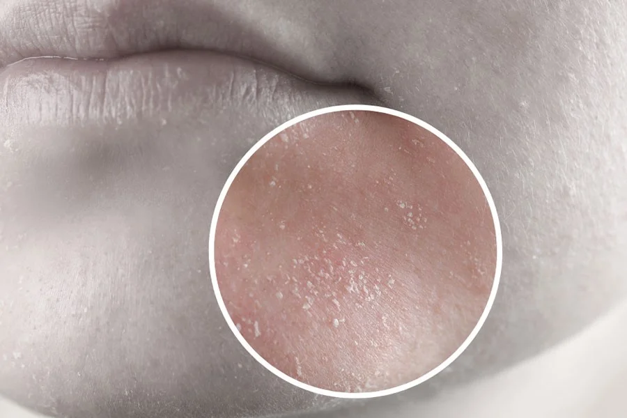 دهیدراته شدن یکی از انواع پوست نیست